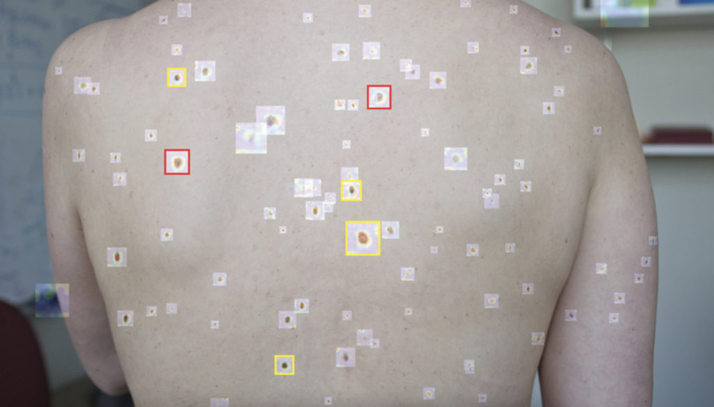 Deep Learning In Healthcare: How Neural Networks Help Detect Melanoma - photo 2